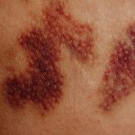 O aumento do câncer de pele no Brasil e as regiões com mais casos